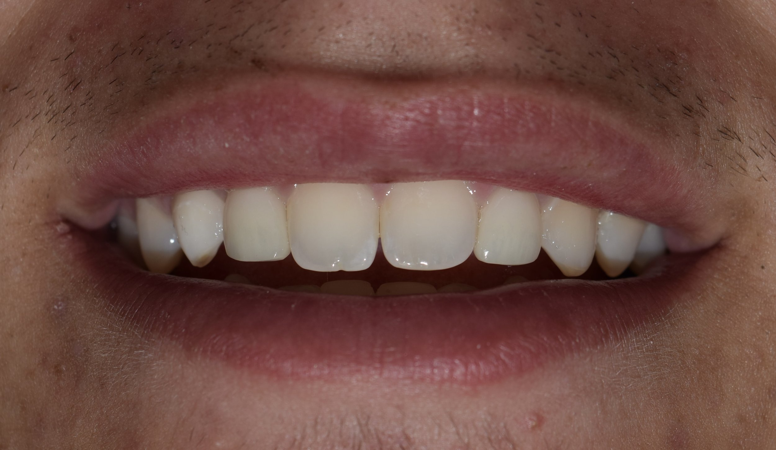 Before