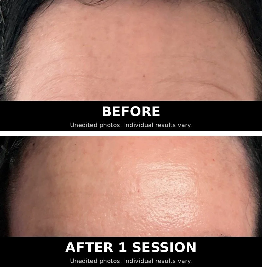 Before and after PRP microneedling on the forehead after one session