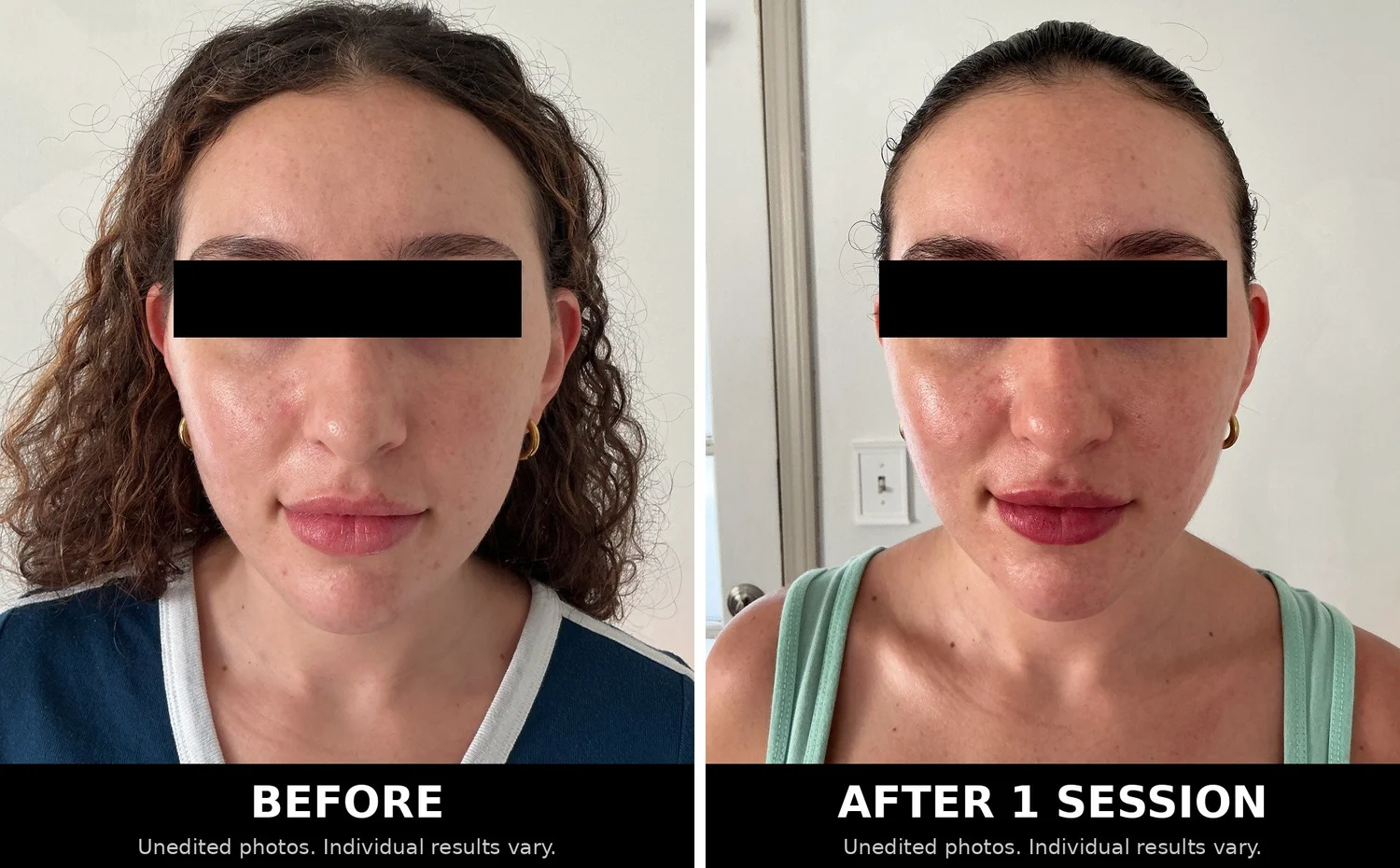 Before and after PRP microneedling on the full face after one session
