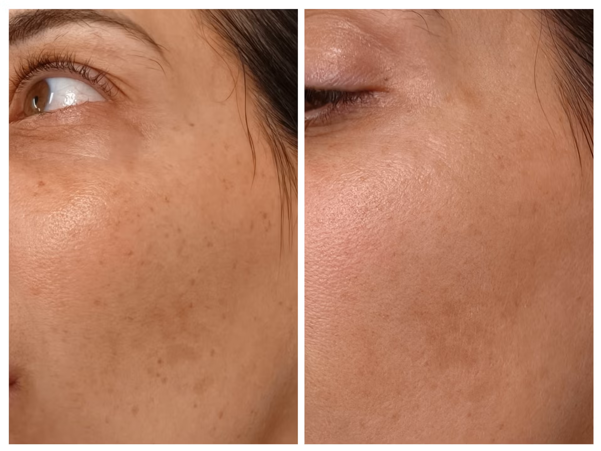 Sun damage before and after treatment - 1 session