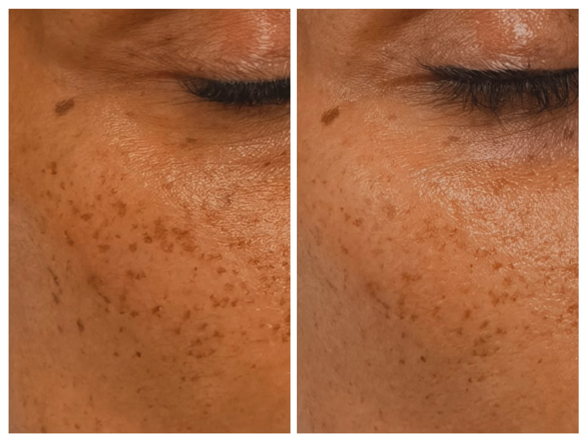 Sun damage before and after treatment - 1 session