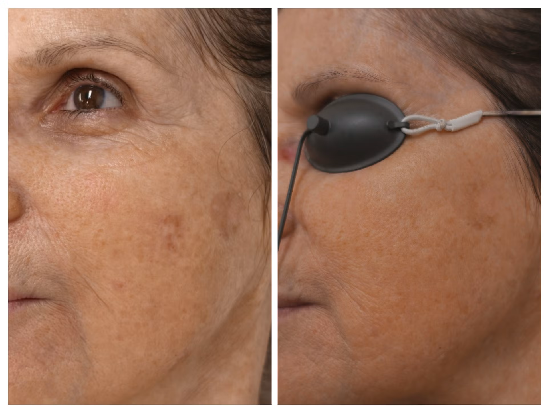 Pigmentation before and after treatment - 1 session