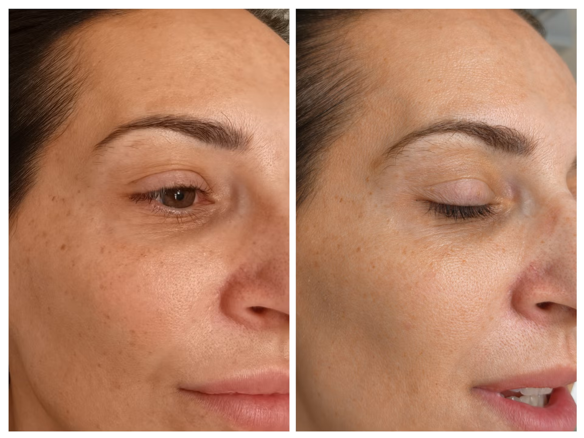 Pigmentation before and after treatment - 1 session