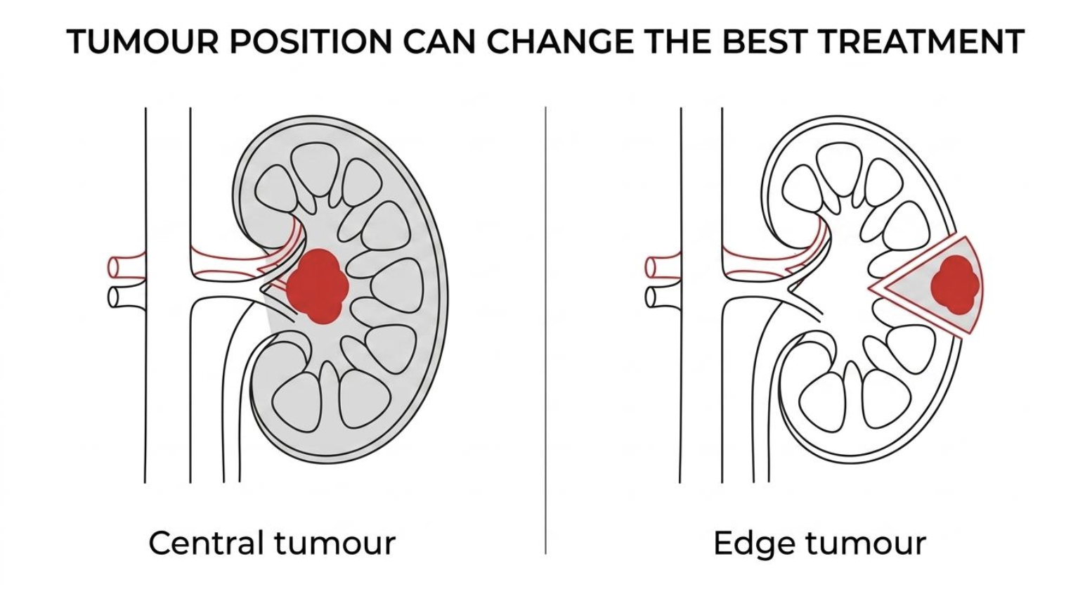 3cm kidney tumour — peripheral tumour near the outer edge versus central tumour close to major vessels and the collecting system