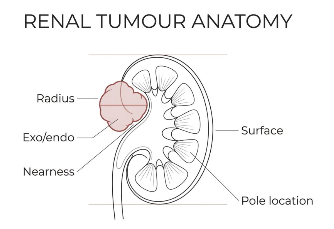 Illustrated kidney with a tumour labelled for radius, exophytic or endophytic growth, nearness to the collecting system, anterior or posterior surface, and position relative to the polar lines