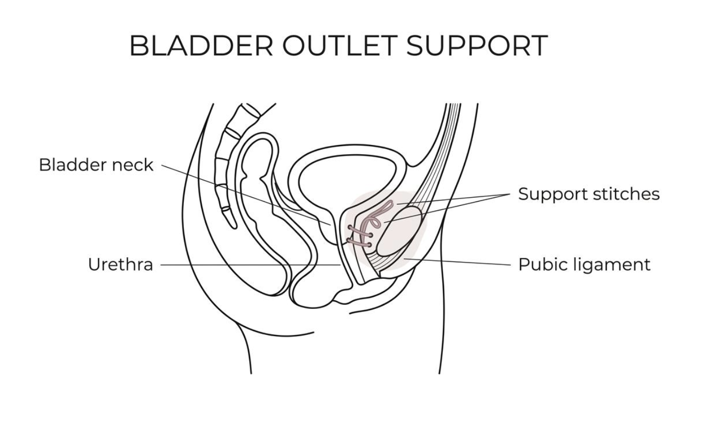Colposuspension — diagram showing stitches placed beside the bladder neck and urethra, attached to the iliopectineal ligament behind the pubic bone to lift and support the bladder outlet