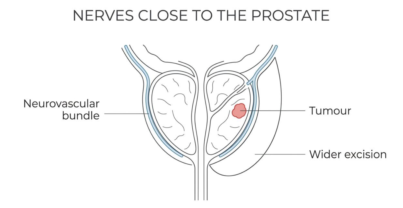 Anatomical diagram showing the prostate and nearby neurovascular bundles — illustrating how surgery in this area can affect the nerves responsible for erectile function