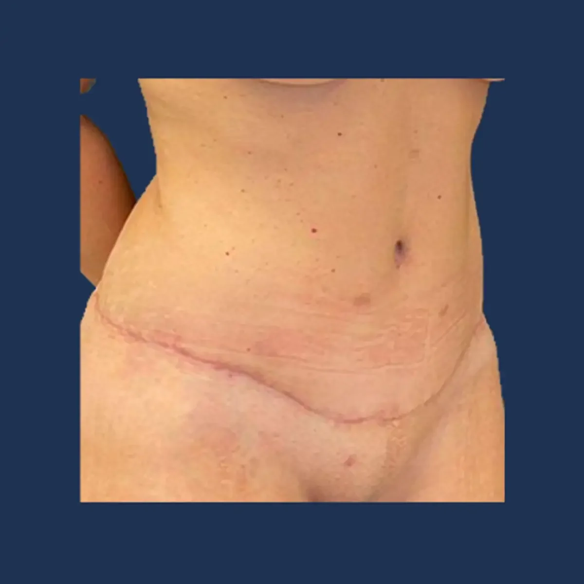 Tummy tuck after photograph, patient three