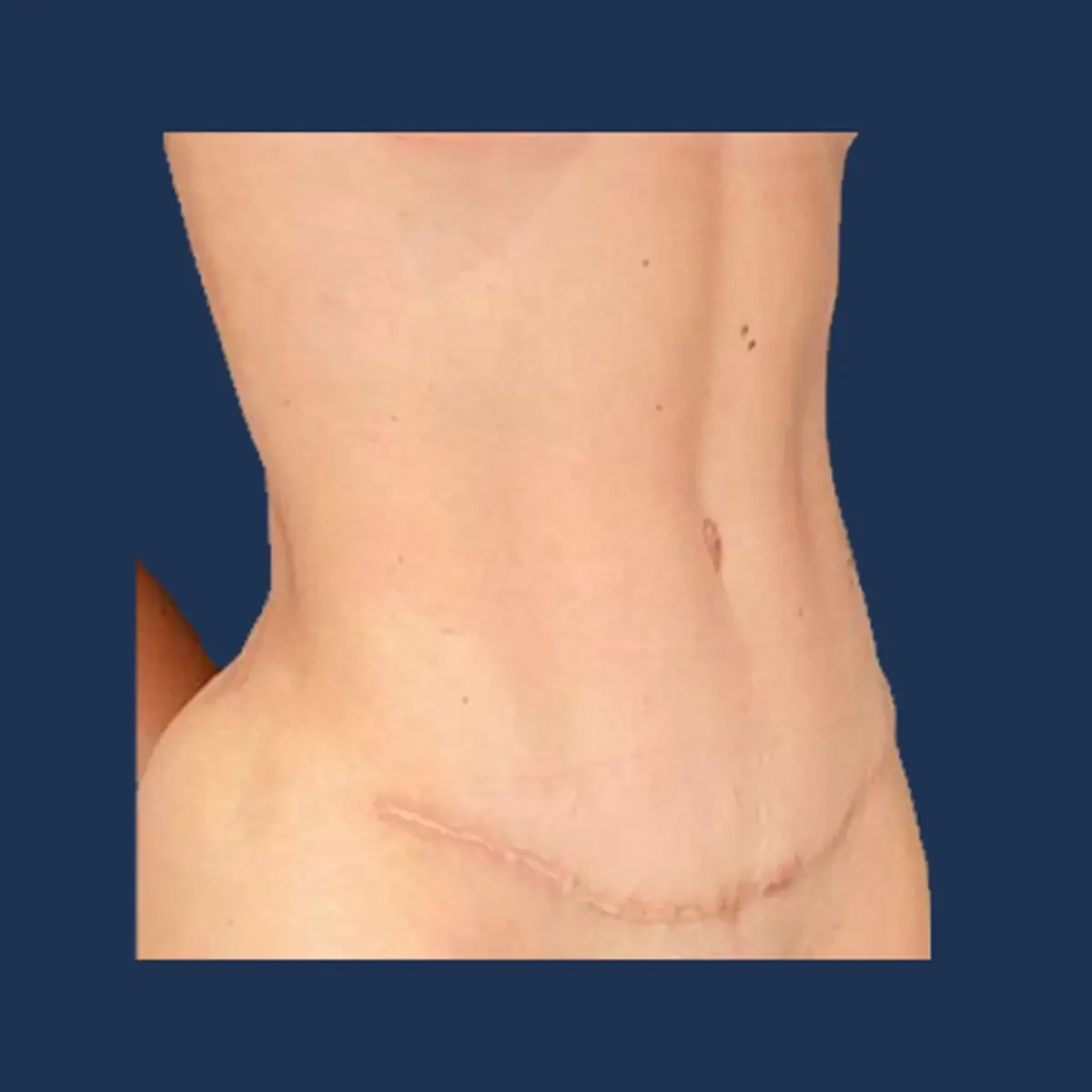 Tummy tuck after photograph, patient two