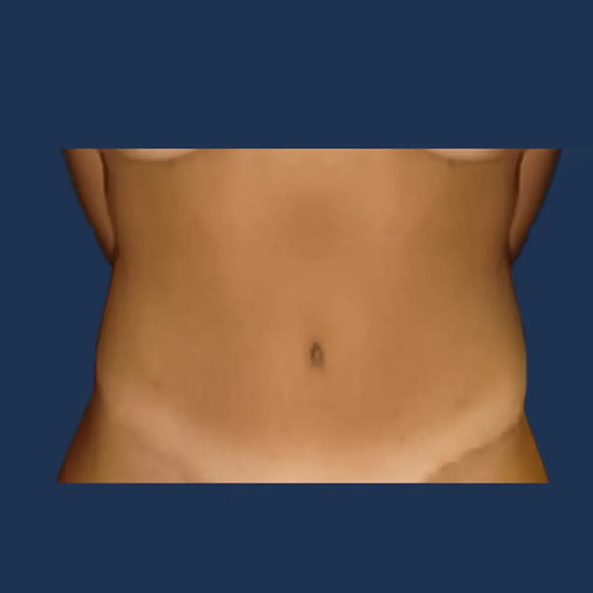 Tummy tuck after photograph, patient one