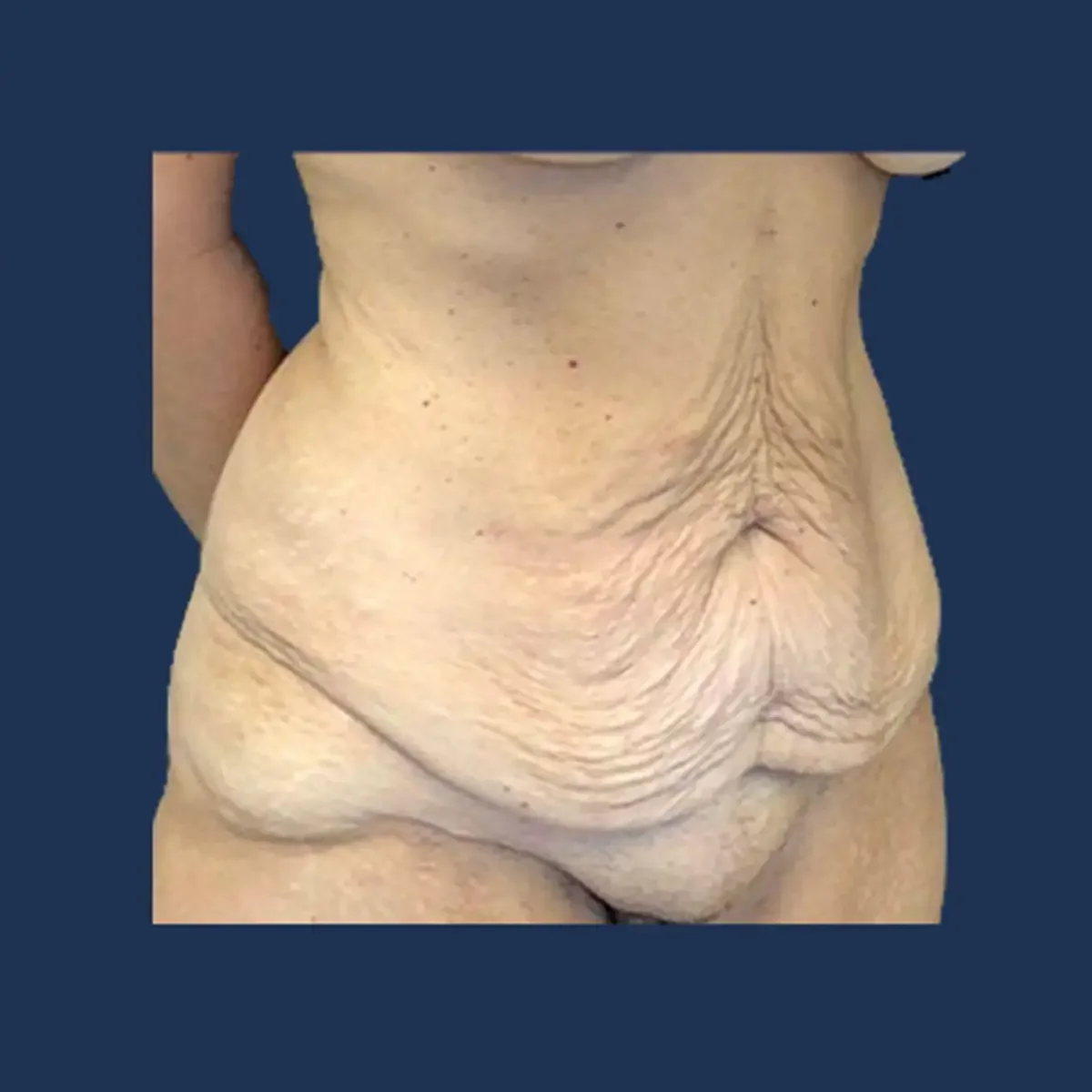 Tummy tuck before photograph, patient three