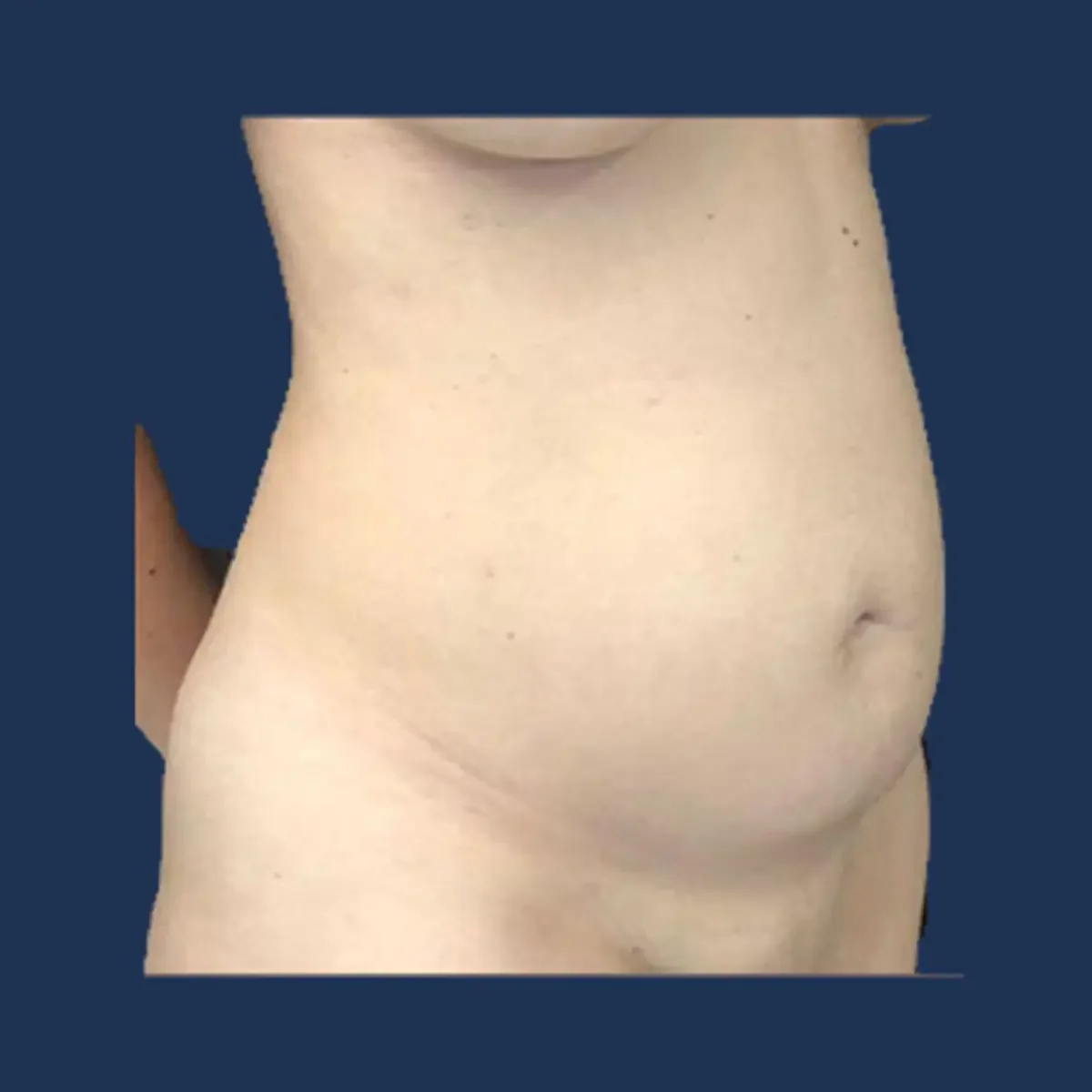 Tummy tuck before photograph, patient two