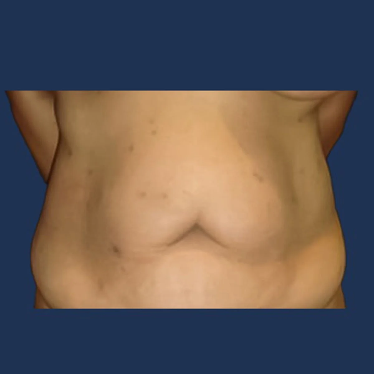 Tummy tuck before photograph, patient one