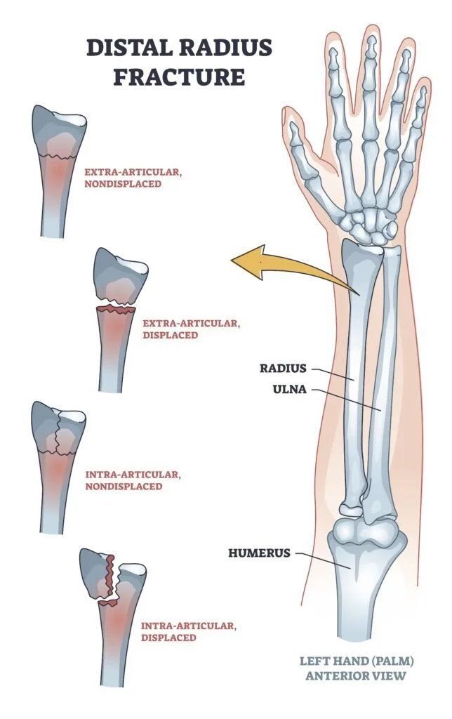 Types of distal radius fracture