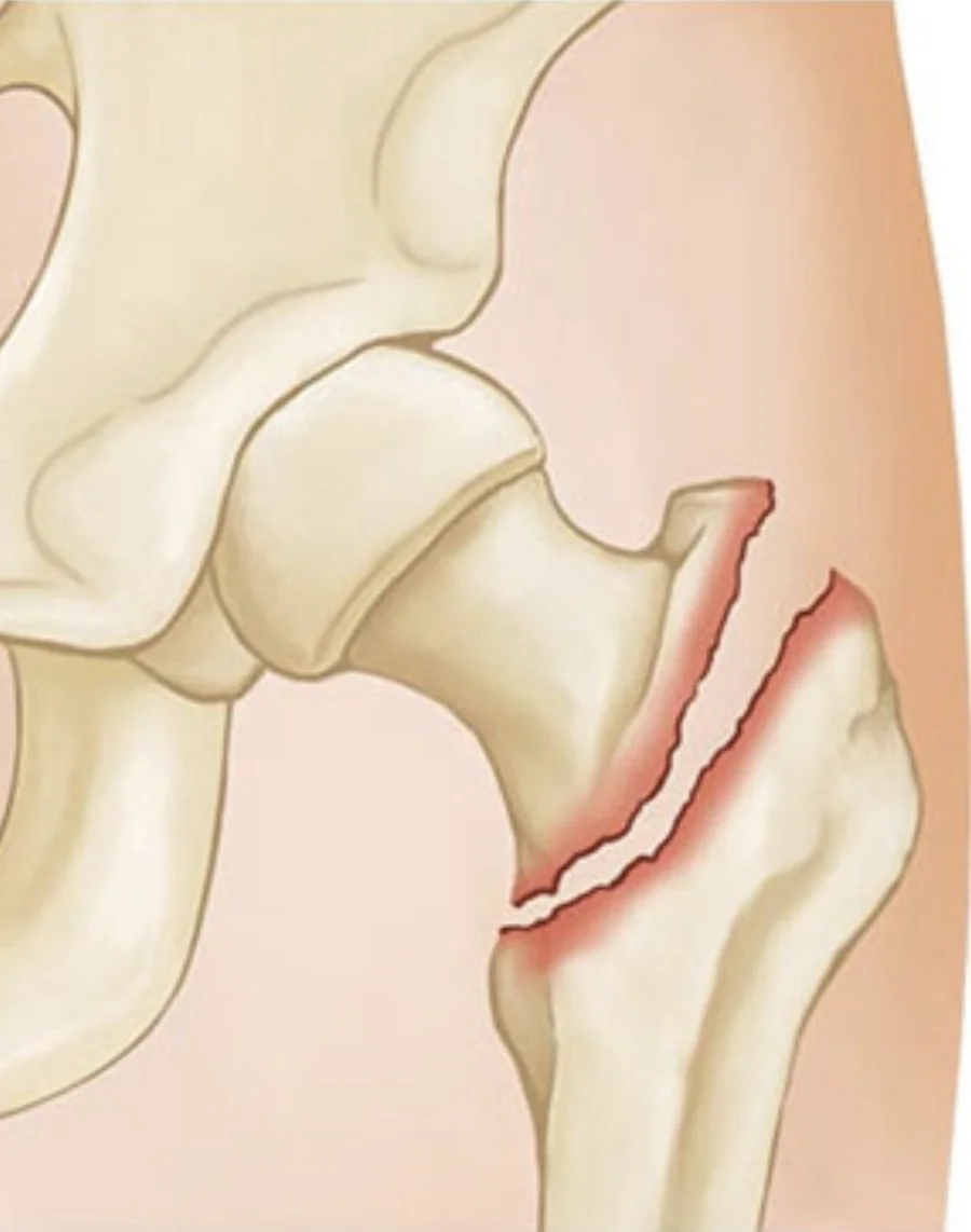 Diagram of an intertrochanteric hip fracture