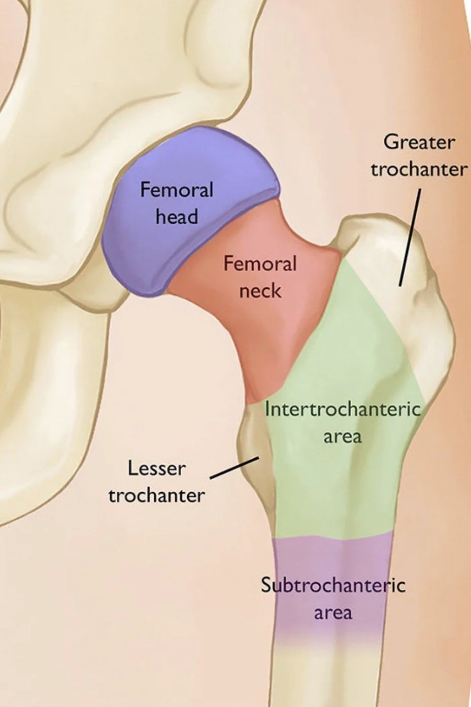 Color-coded diagram of hip fracture zones: femoral head, femoral neck, intertrochanteric area, and subtrochanteric area
