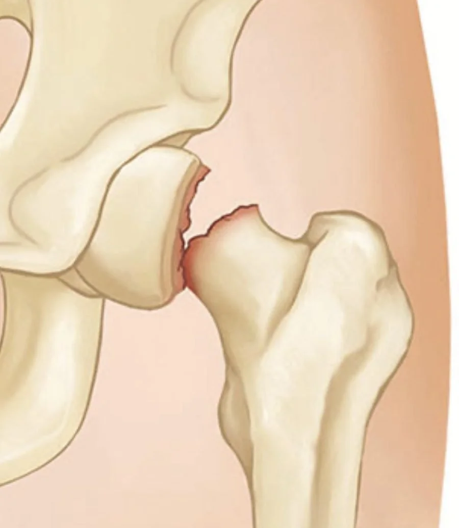 Diagram of a displaced femoral neck fracture
