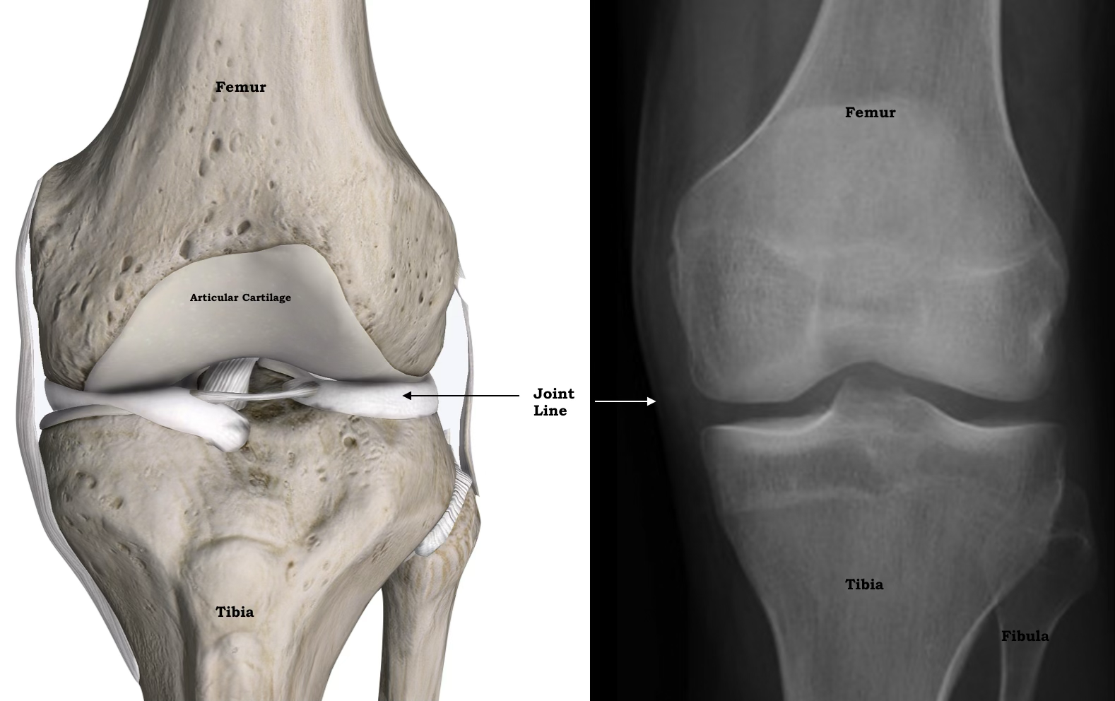 A normal knee: anatomy next to X-ray, showing the joint line