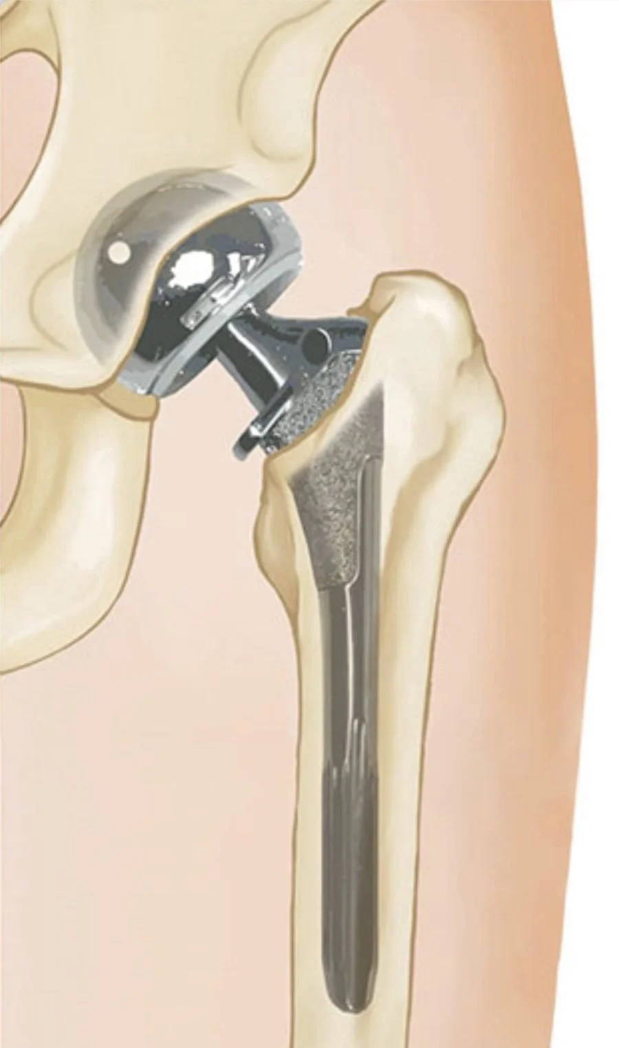 Diagram of a total hip replacement for femoral neck fracture