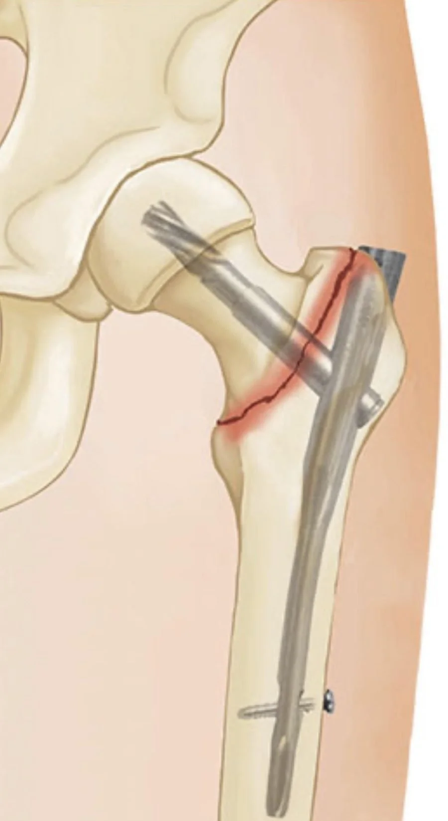 Diagram of an intertrochanteric hip fracture fixed with the Stryker Gamma 4 nail