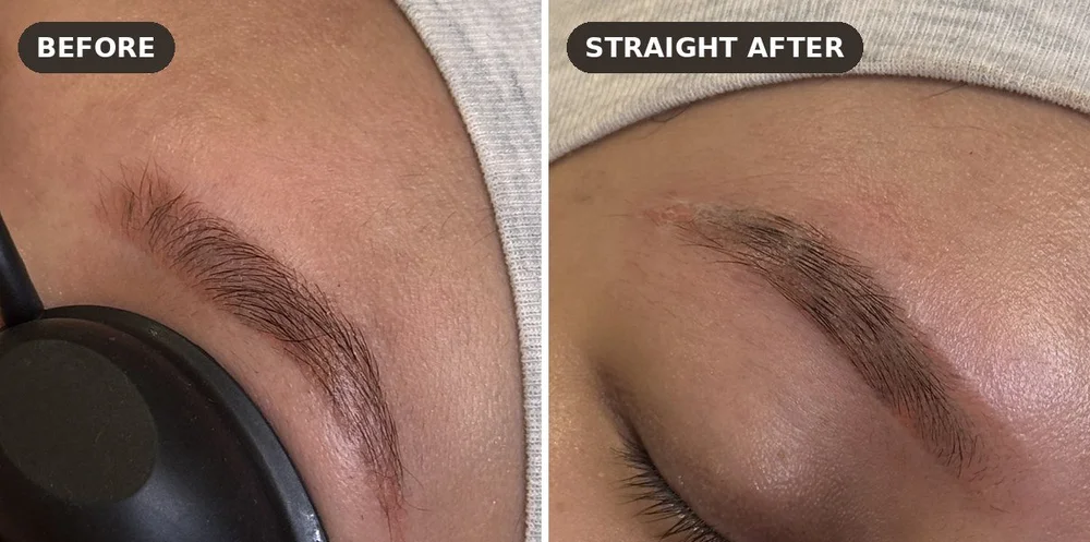 Microbladed eyebrow before and straight after a Skyn X laser tattoo removal session at Skyn Lab