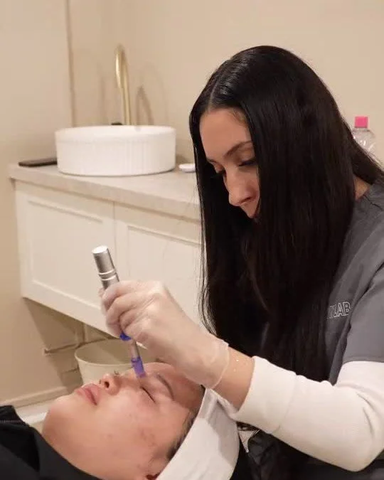 Skin needling treatment at Skyn Lab Keilor East