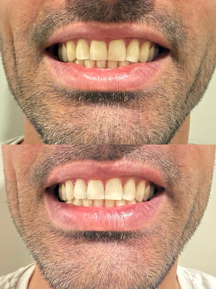 Smile before and after cosmetic teeth whitening at Skyn Lab