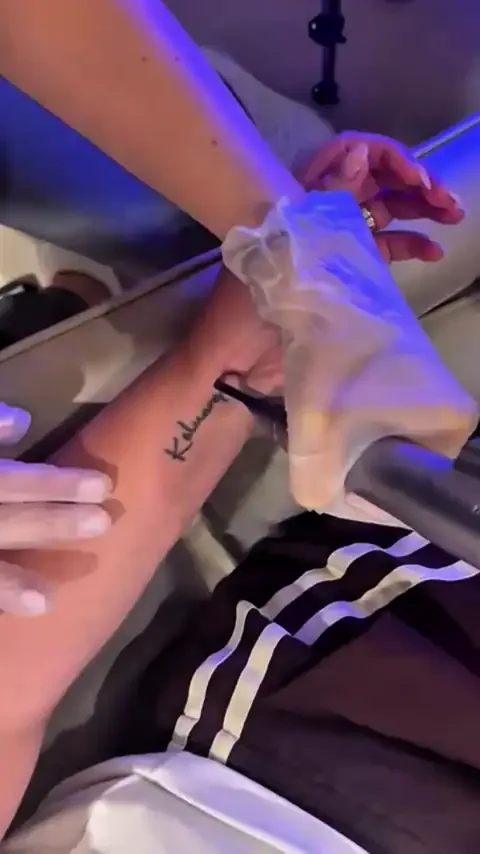 Tattoo frosting appearing on skin straight after a Skyn X laser tattoo removal pass