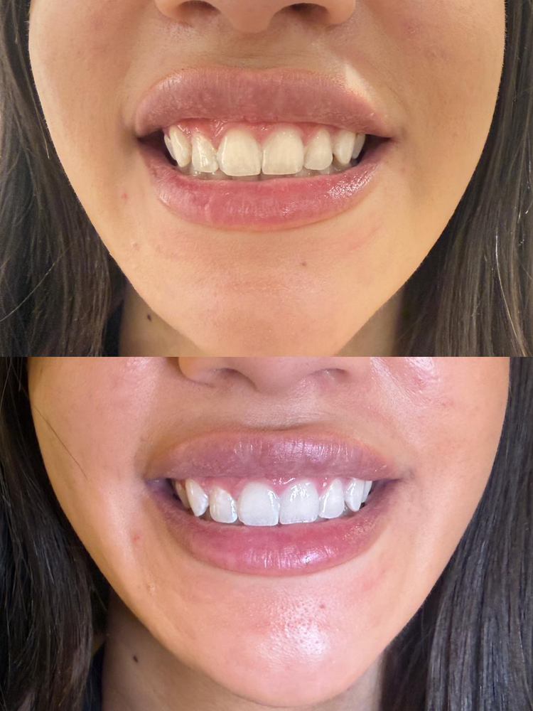 Smile before and after cosmetic teeth whitening at Skyn Lab