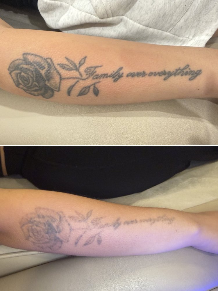 Laser tattoo removal progress at Skyn Lab