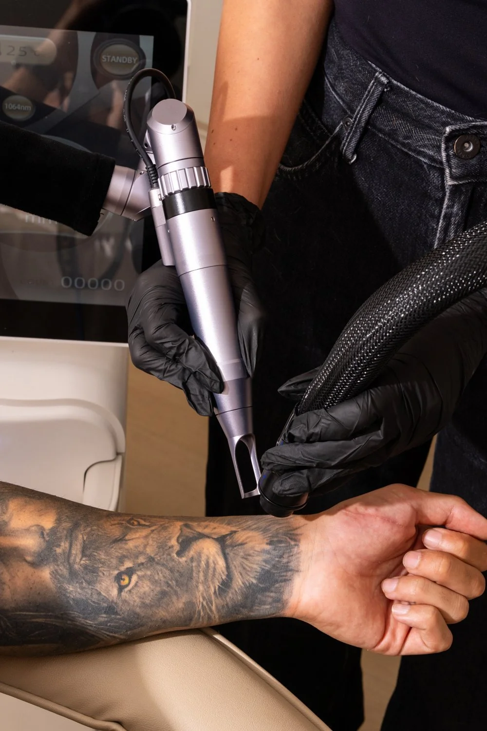 Skyn X laser tattoo removal on a forearm tattoo at Skyn Lab Keilor East