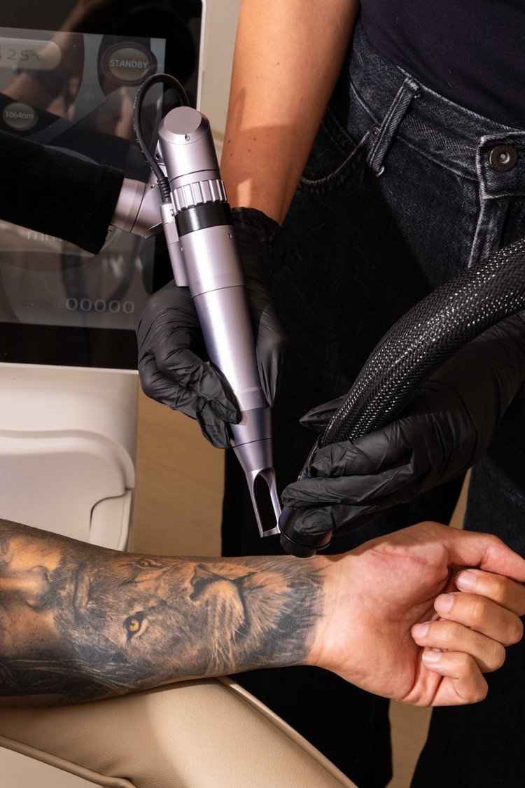 Laser tattoo removal at Skyn Lab