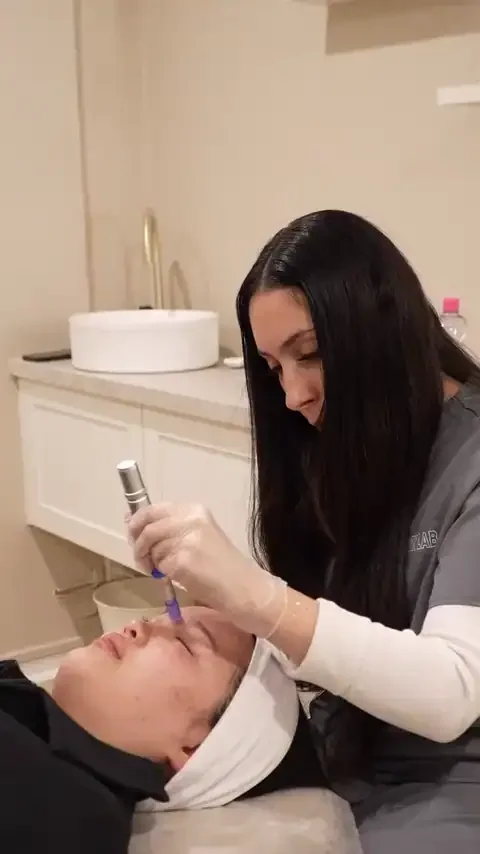Close up of a skin needling pen on the face at Skyn Lab