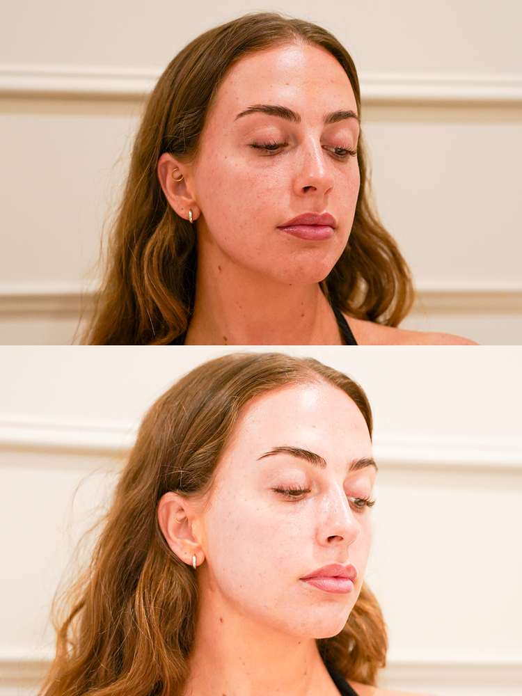 Skin before and after a skin treatment at Skyn Lab