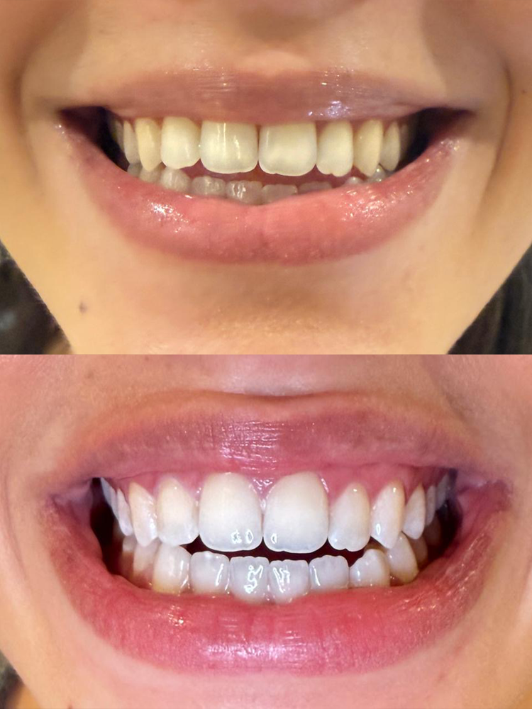 Smile before and after cosmetic teeth whitening at Skyn Lab