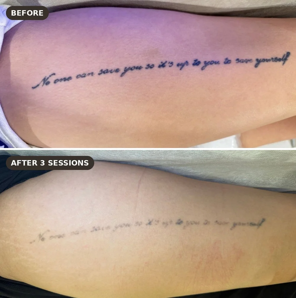 Script tattoo on the thigh before and after 3 sessions of laser tattoo removal at Skyn Lab