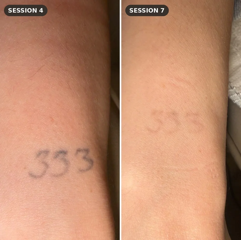 Number tattoo on the wrist at session 4 and session 7 of laser tattoo removal at Skyn Lab Keilor East