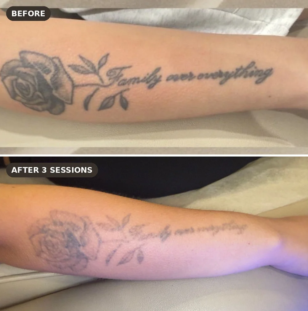 Rose and script forearm tattoo before and after 3 sessions of laser tattoo removal at Skyn Lab