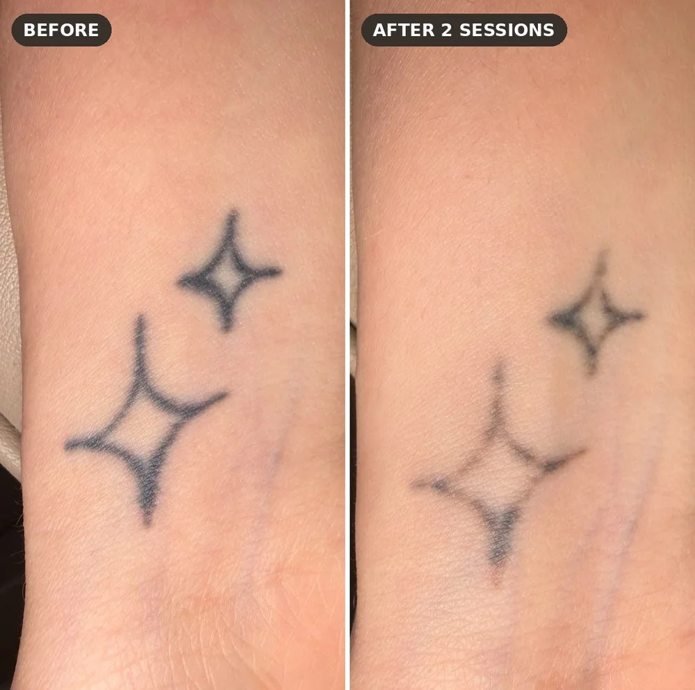 Star tattoos on the wrist before and after 2 sessions of laser tattoo removal at Skyn Lab