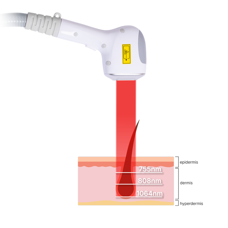 Skyn Lux three wavelength diode laser reaching the hair follicle