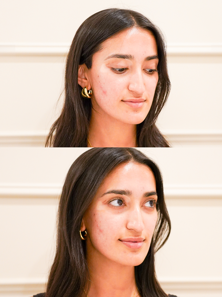Skin before and after a skin treatment at Skyn Lab