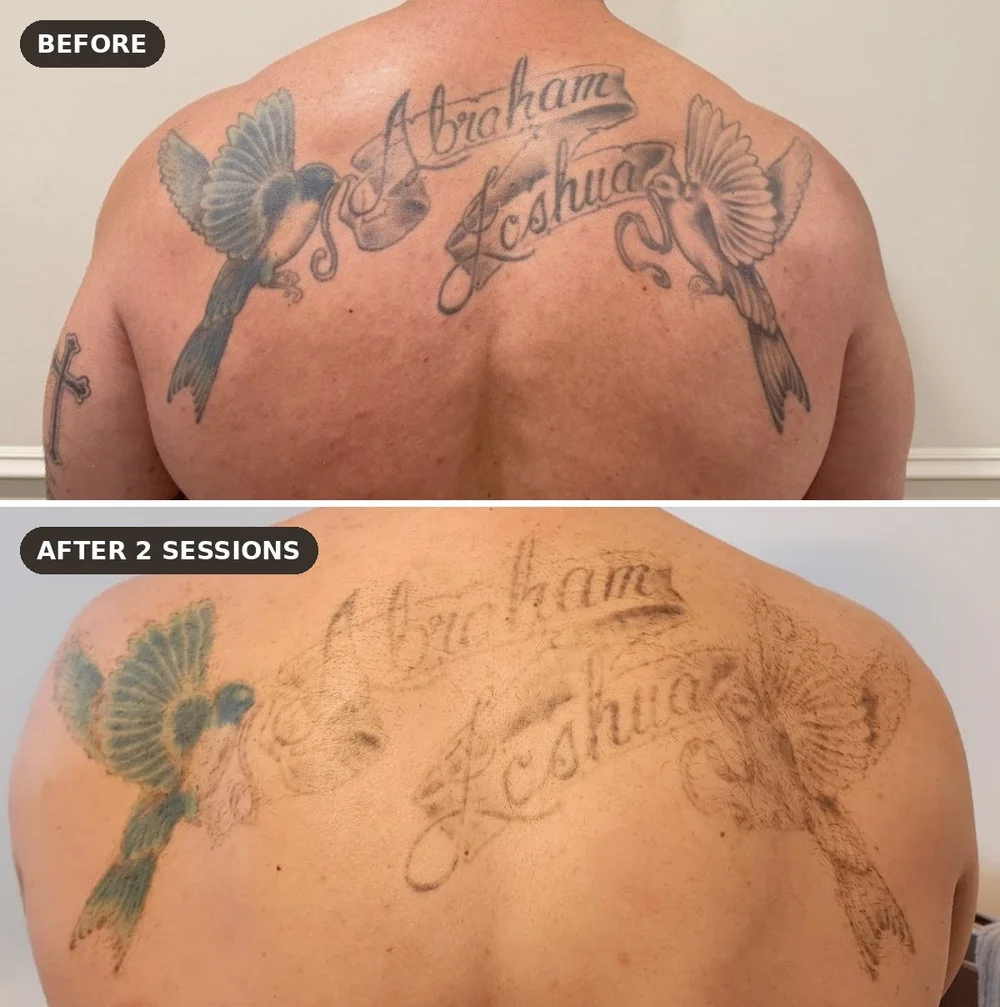 Upper back tattoo before and after 2 sessions of laser tattoo removal at Skyn Lab