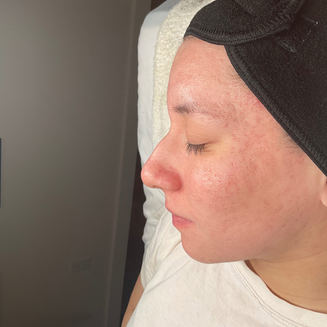 After Treatment