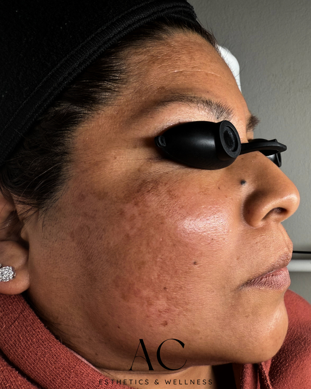 Before Treatment