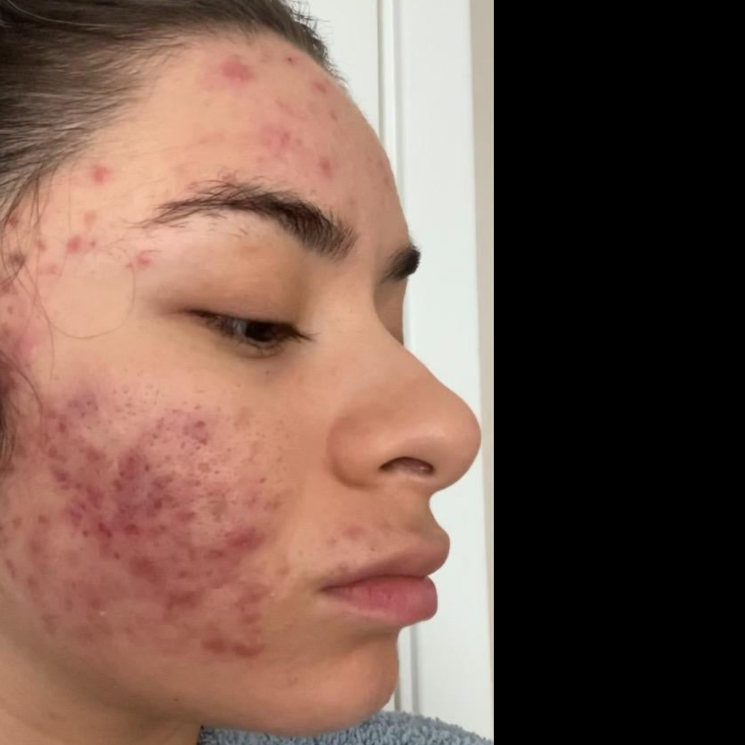 Before Treatment