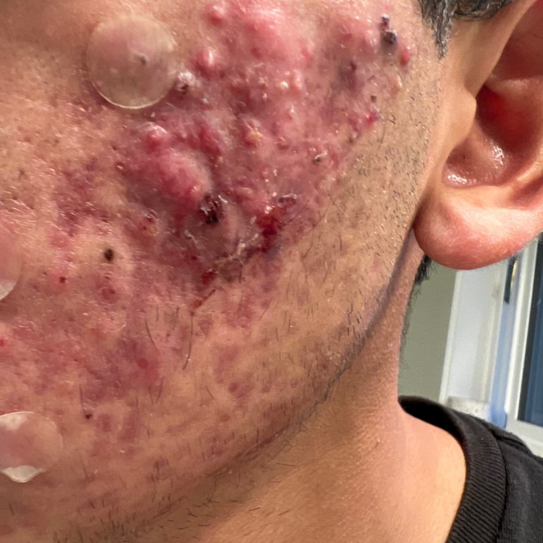 Before Treatment