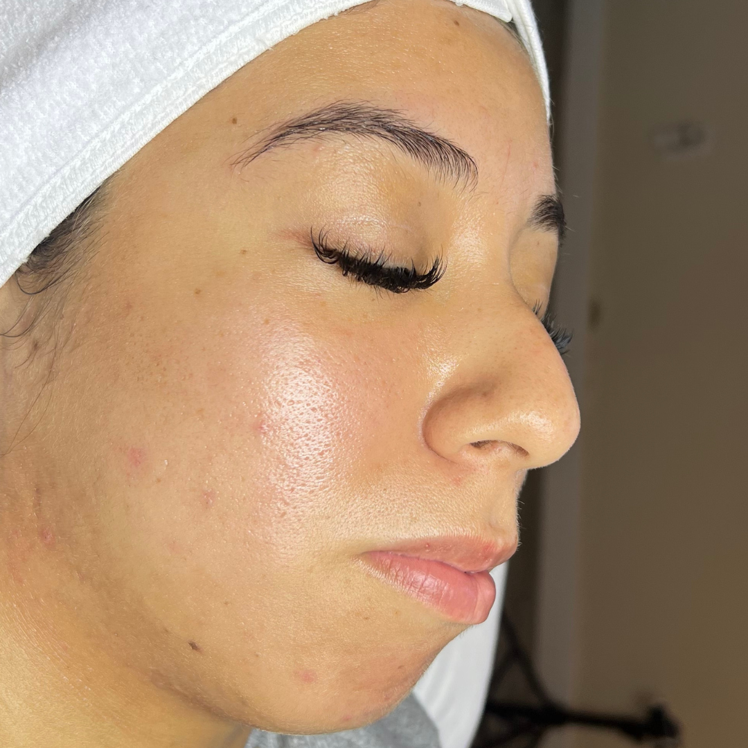 After Treatment