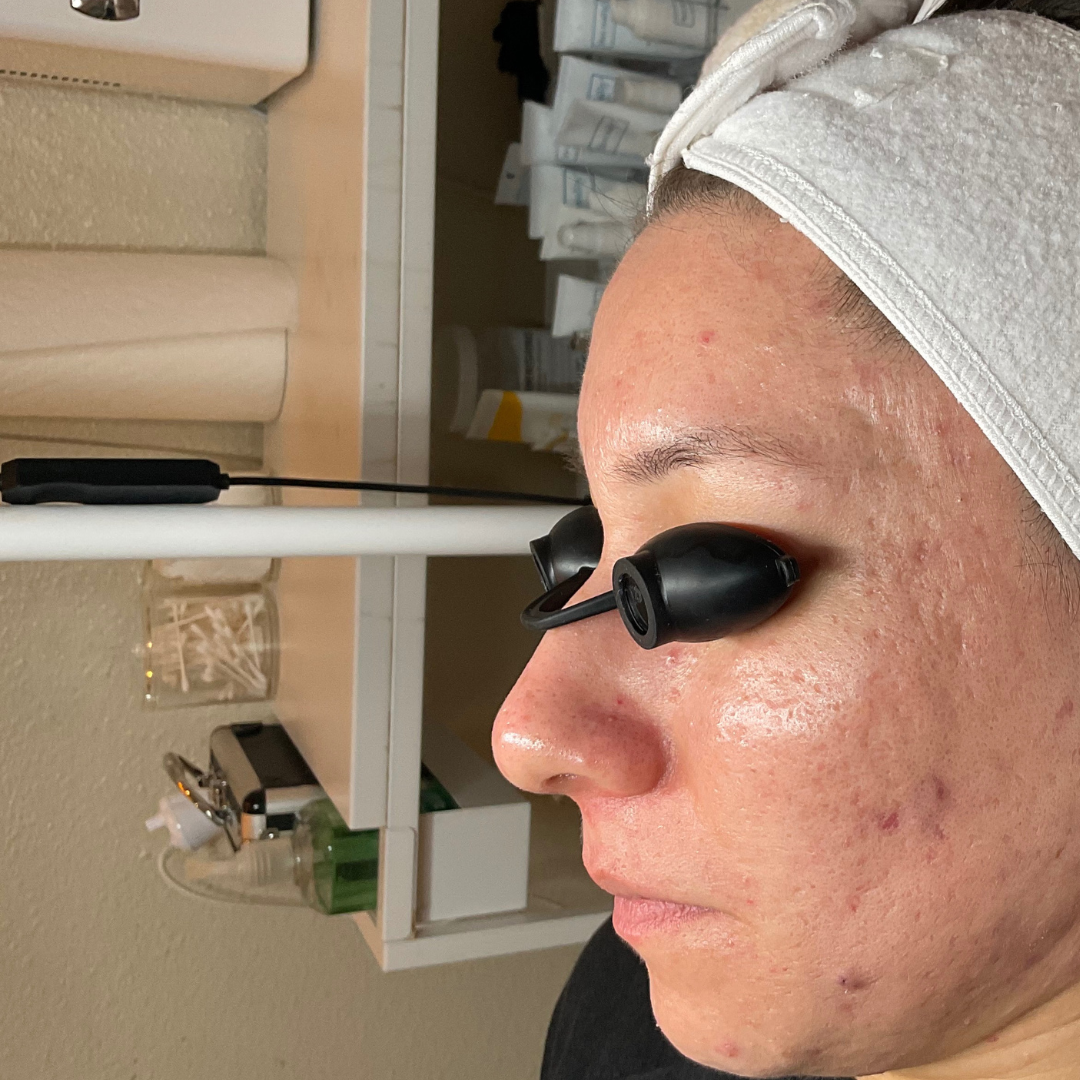 Before Treatment