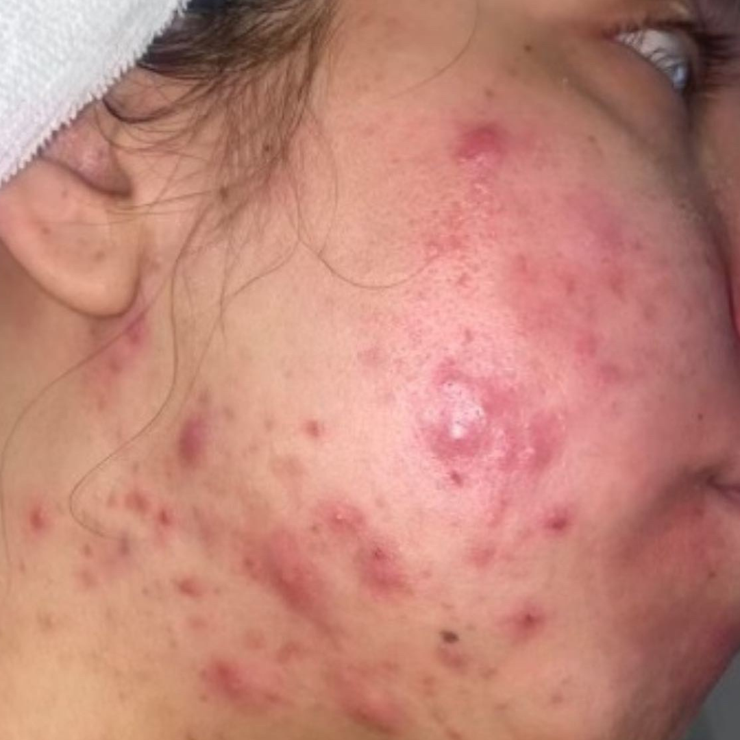Before Treatment