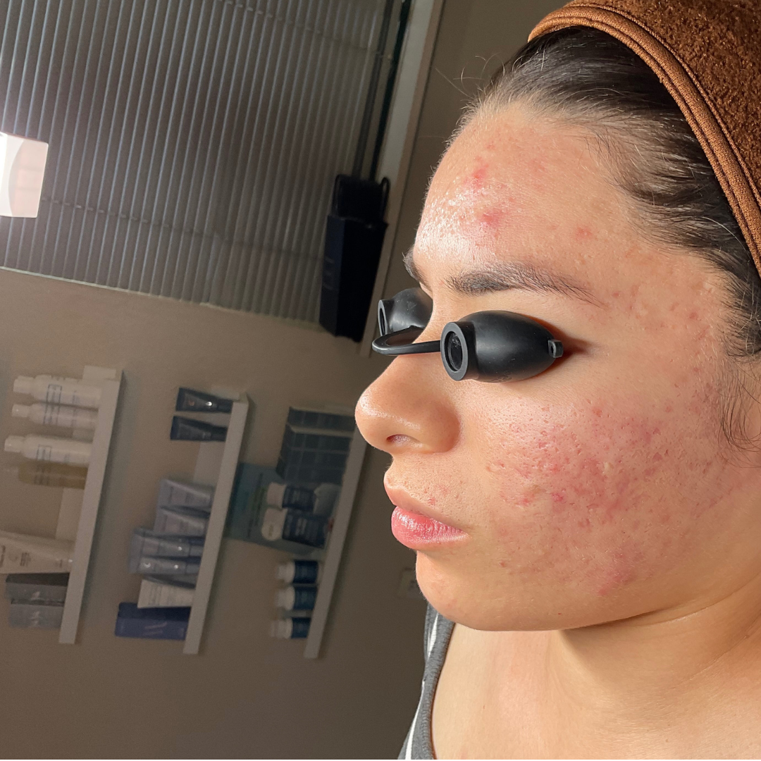 After Treatment